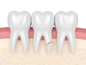 A set tooths in which one tooth tip is broken.
