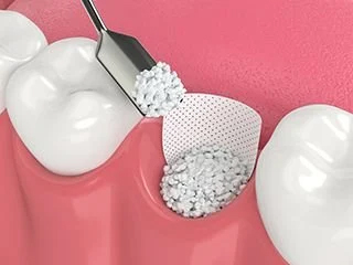 Filling grafting material in teeth gap