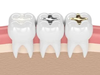 Teeths filled with Composite Resin, Amalgam and gold