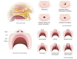 Cleft lip and palate surgery diagram
