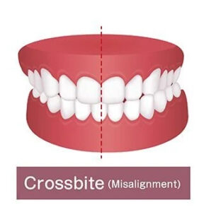 Crossbite tooth set