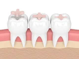 Inlay layer of ceramic in the teeth