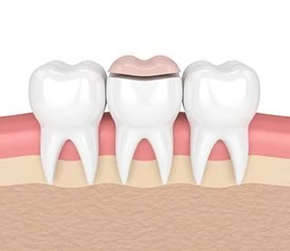 Onlay layer of ceramic on the tooth