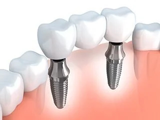 Multi gap filled with double bridge implant