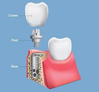 Example diagram of Dental implant