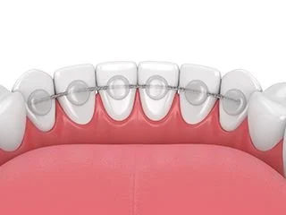Fixed bonded teeth braces