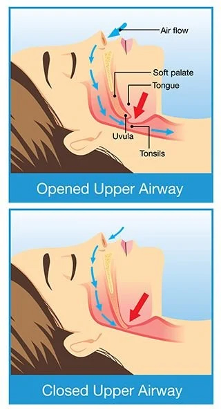 Instruction of snoring and sleep apnea