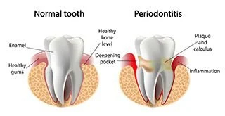 Example of Normal tooth and Periodontitis tooth