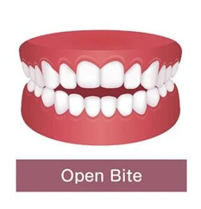 Open Bite tooth set