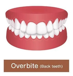 Overbite tooth set