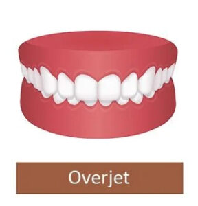 Overjet tooth set