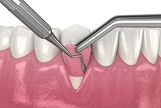 Replacing gum tissues around tooth