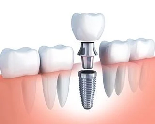 Single gap filled with single implant