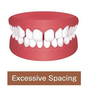 Excessive Spacing tooth set