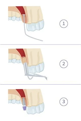 Steps of sinus surgery