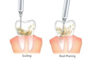 Shown two types of surgical method - Scaling and Root Planing