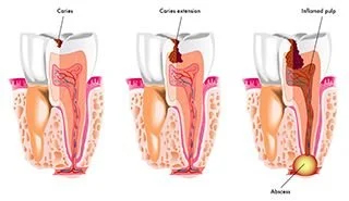 illustration of tooth decay
