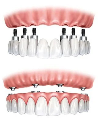Two types of implant supported denture.