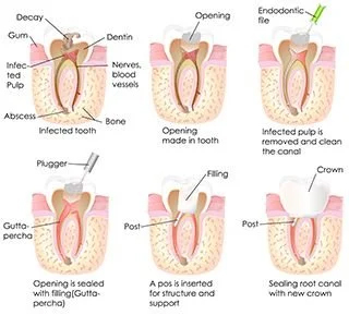 Types of root canal treatments.