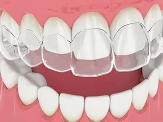 Types of braces - Clear Aligners