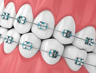 Types of braces - Metal Braces