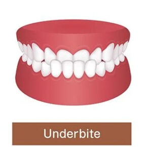 Underbite tooth set