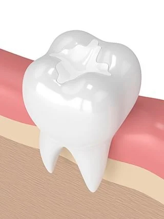 A tooth filled with white color ceramic