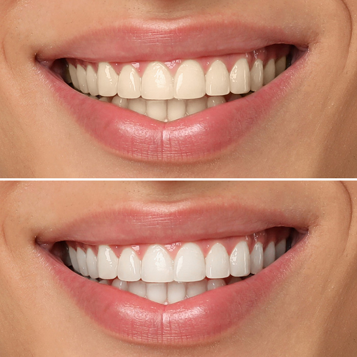 Demarco-Dental-Teeth-Whitening